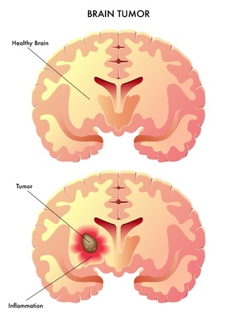 опухоли головного мозга